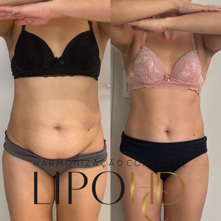 LIPO-HCD