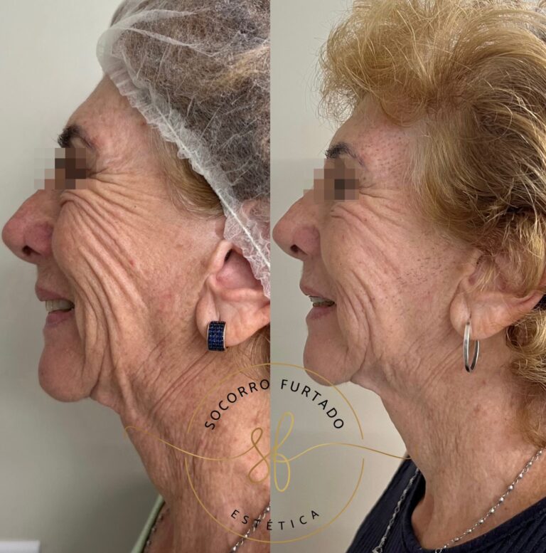 REJUVENESCIMENTO FACIAL